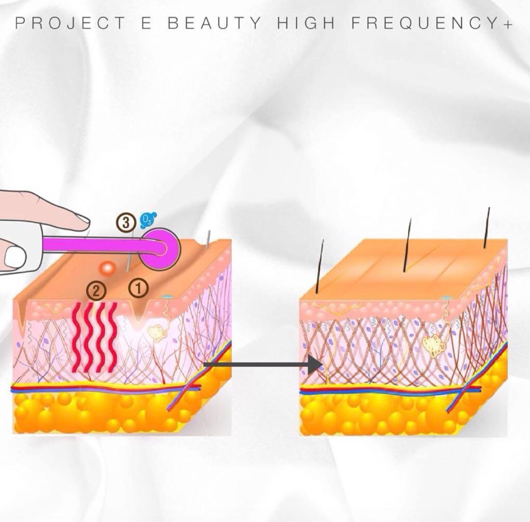 プロジェクトEビューティー高周波デバイス スキンケアデバイス