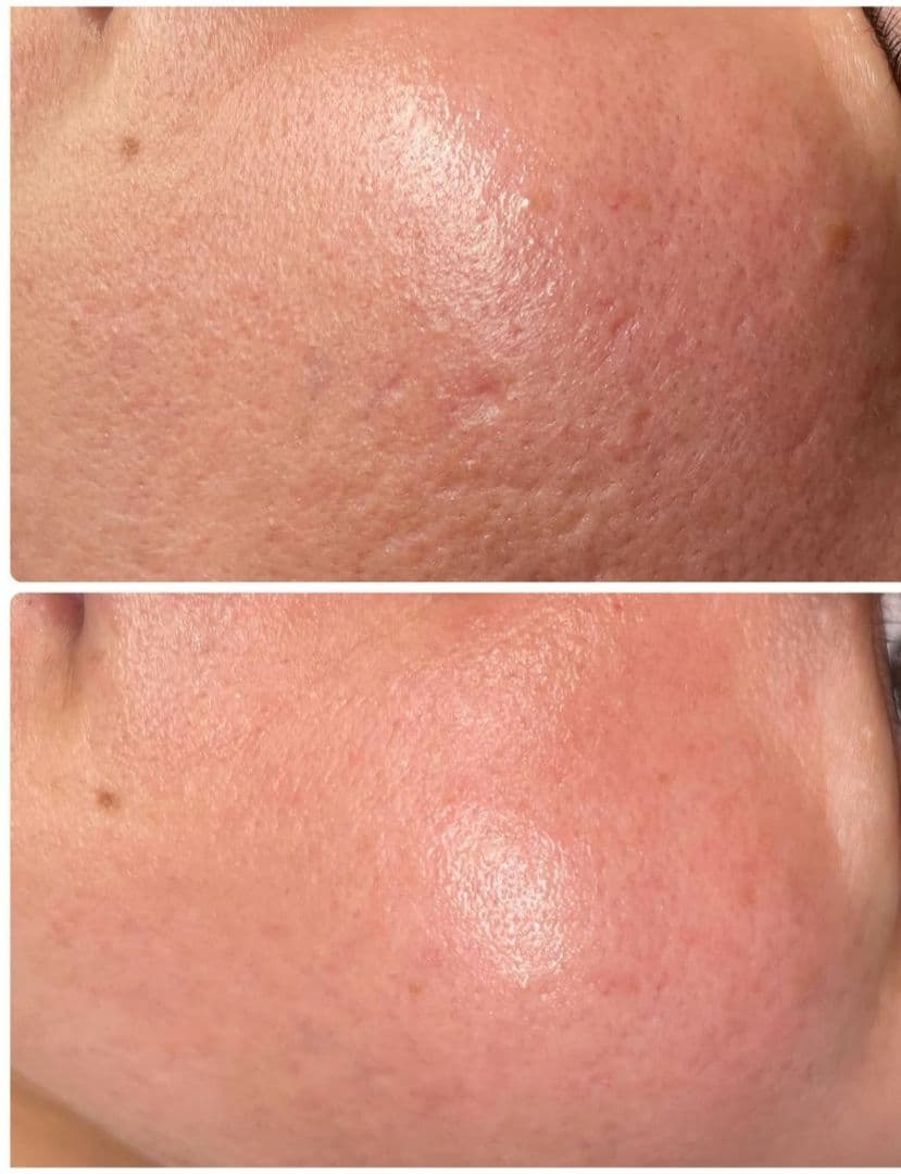 3時間限定価格！プラズマニードルカリファEX　美容液セット