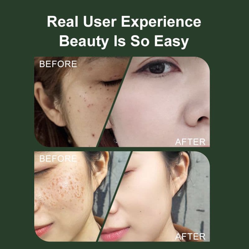 ✨️最安値VLVEE 16段階調整 顔シミ取り美顔器✨️