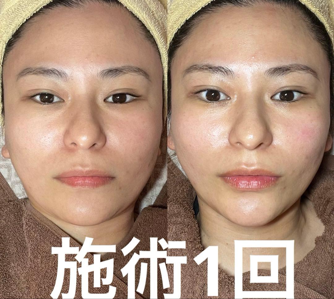 a*i様 プラズマ美容機