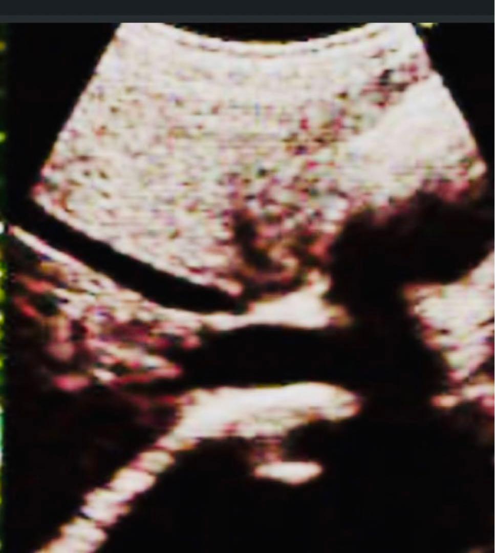 超音波検査装置（エコーゼリー無し）