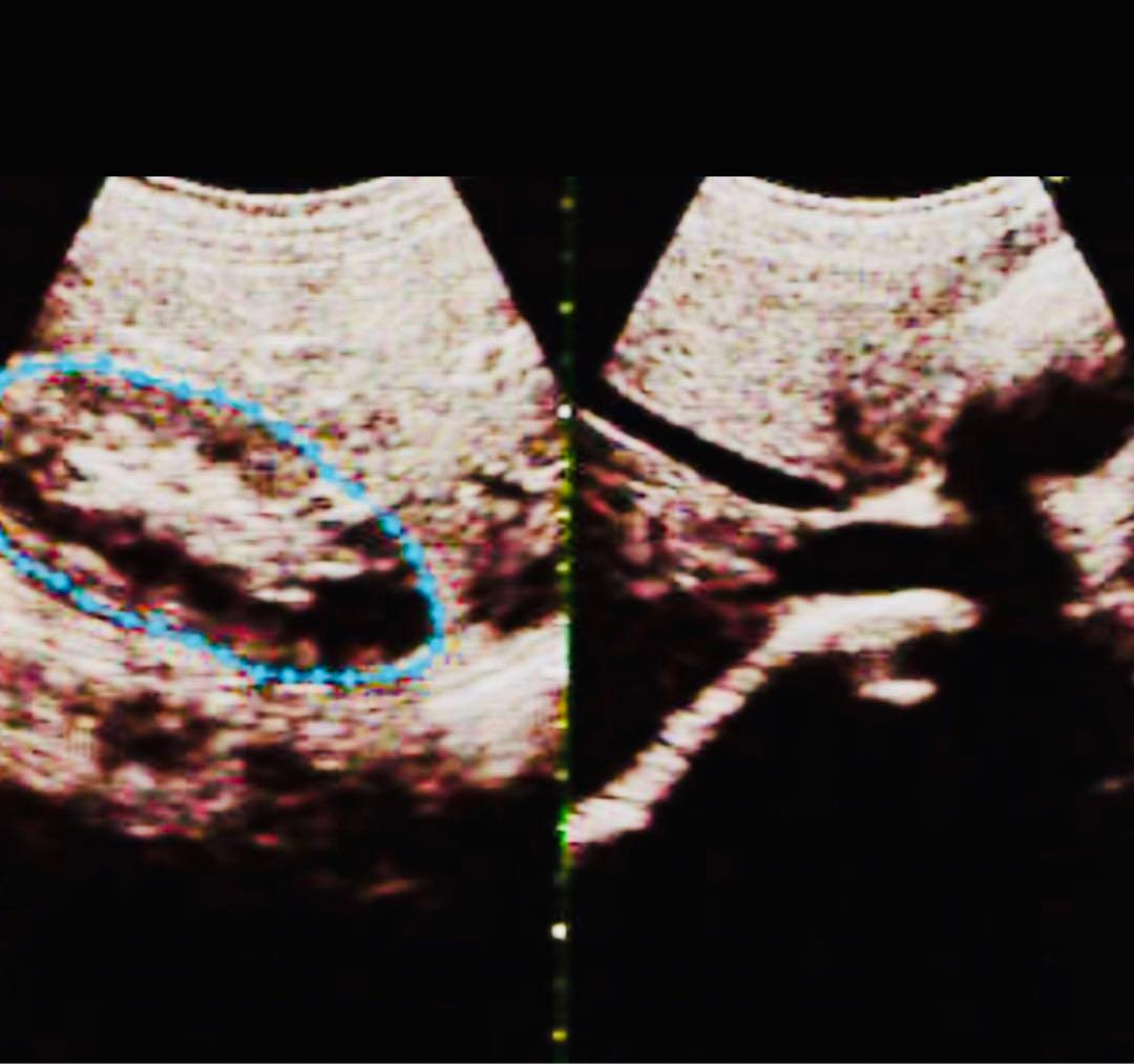 超音波検査装置（エコーゼリー無し）