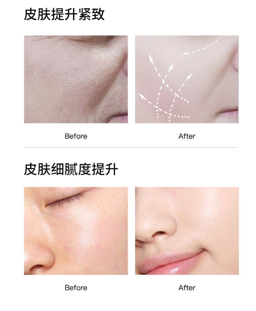 水玉リフティング LDM SONOと同等マシン 韓国肌管理