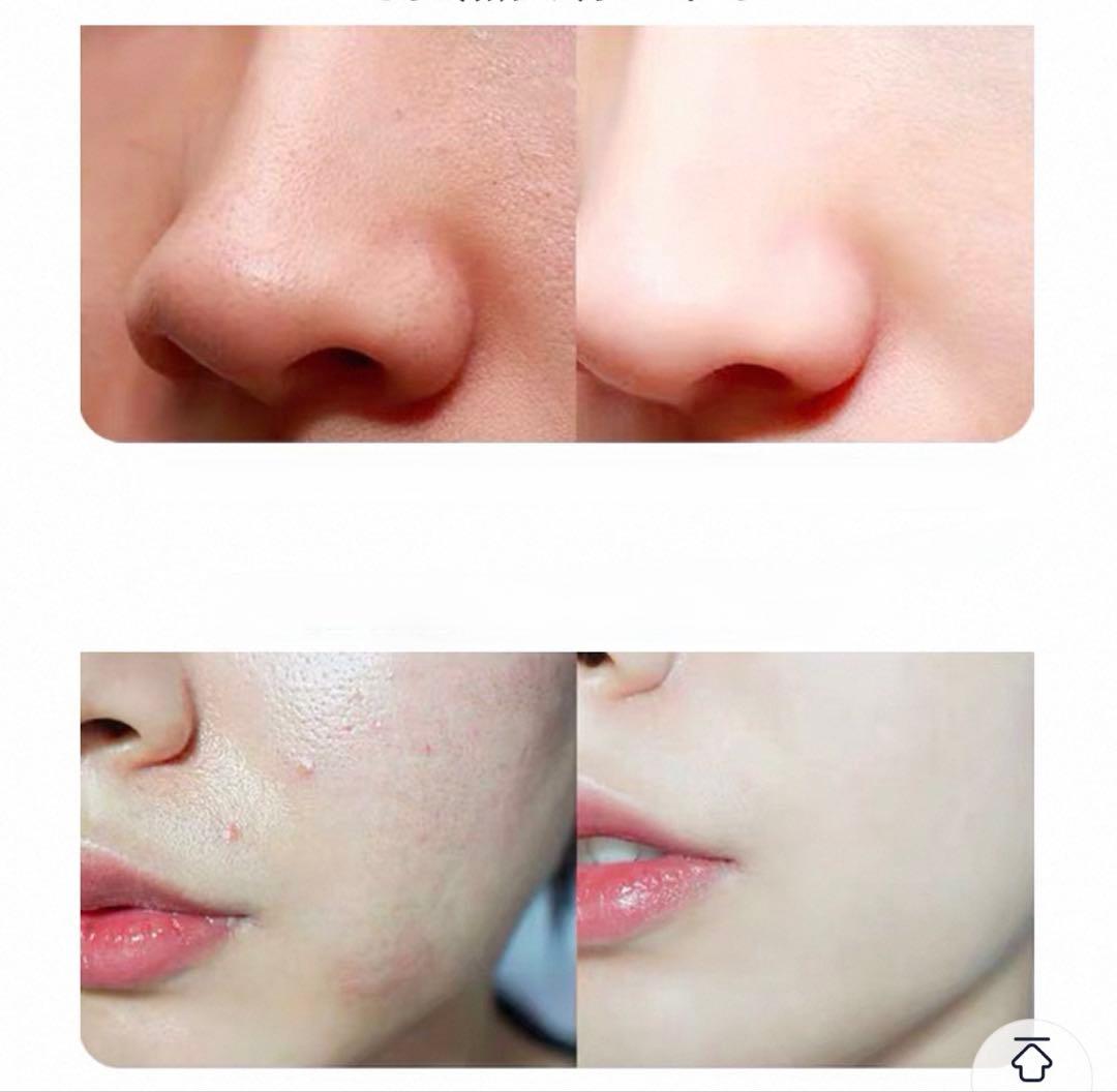 ハイドラ　毛穴洗浄機⭐︎ エステサロン業務用