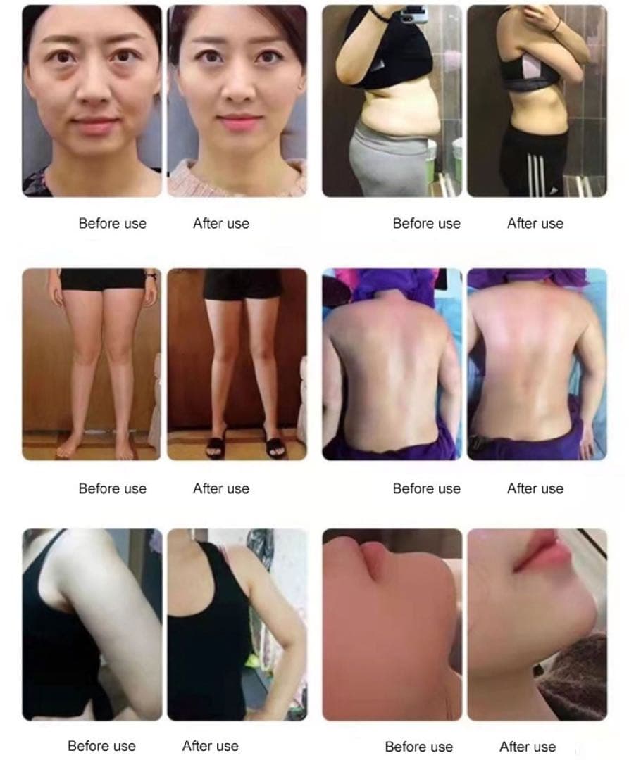 ［2024年インディバ改良版］ハイパーナイフ☆キャビテーション☆痩身☆痛み治療