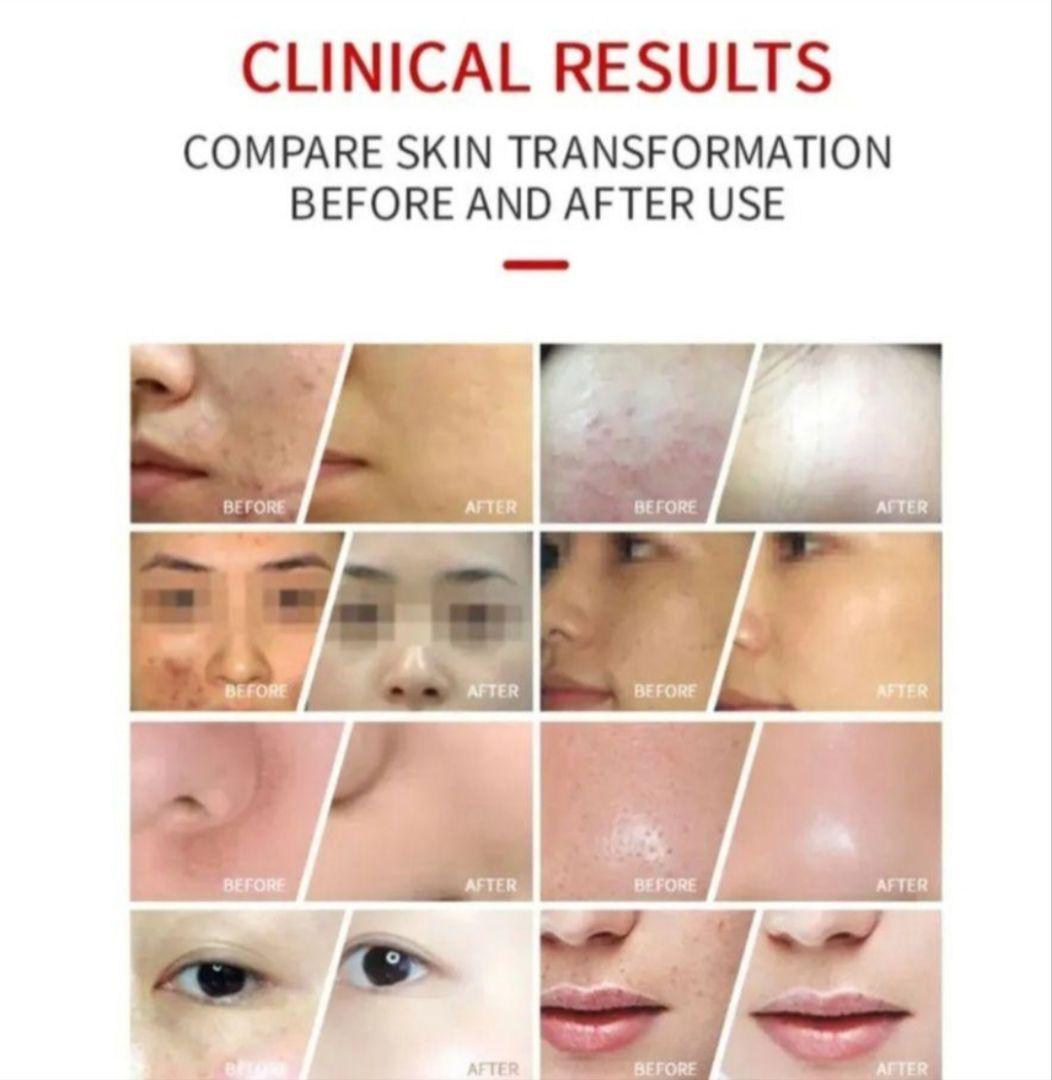 ７色LEDライト美顔器　エステ