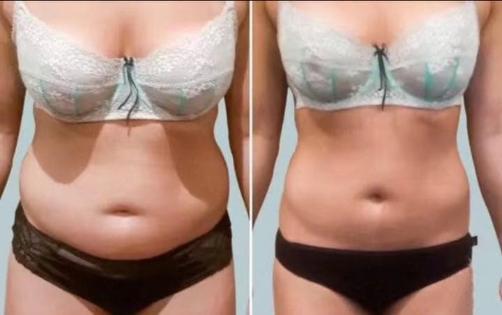 冷凍脂肪溶解 フリーズファット