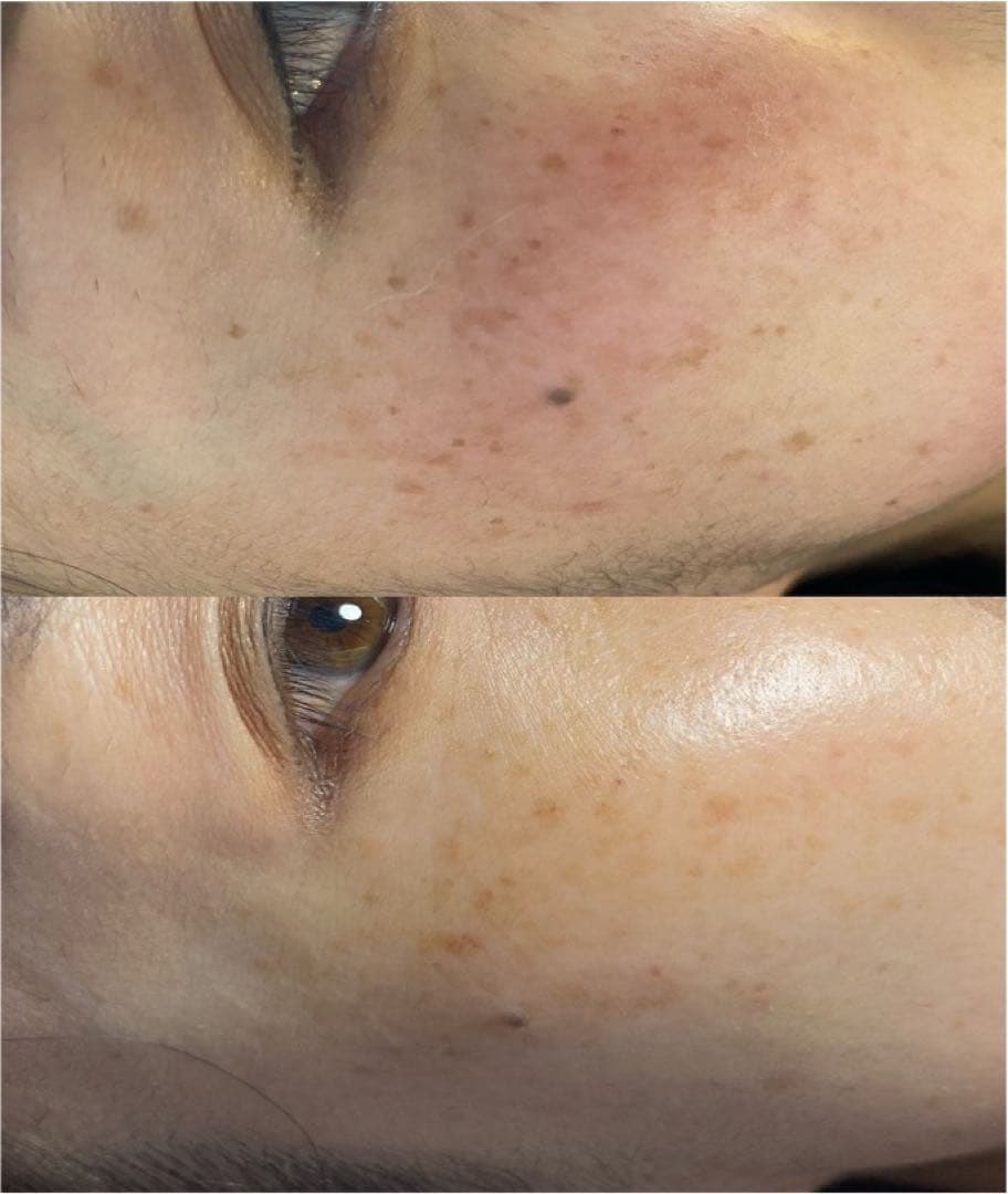 低周波ペンシル　シミケア機　リシルク　ReSilk セット販売