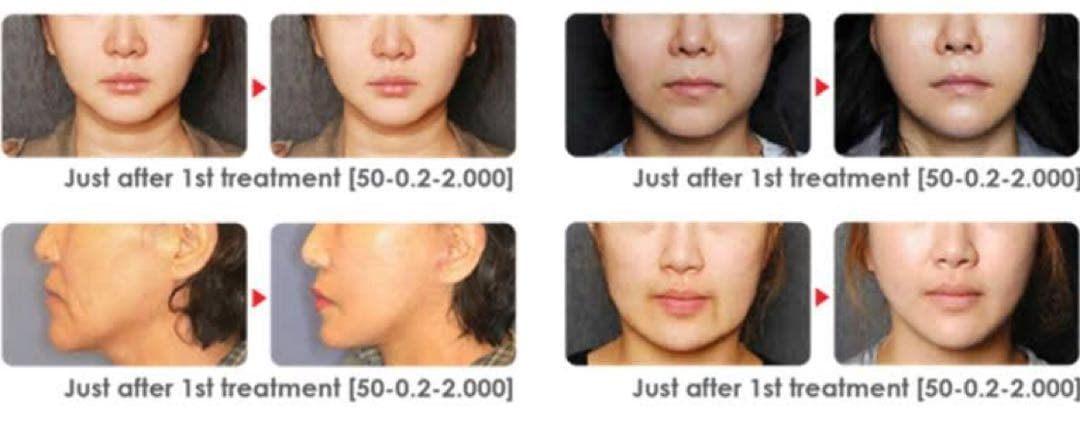 HICSU リフトアップ　業務用美容機器　たるみ　しわ　Vmax 韓国　ハイフ