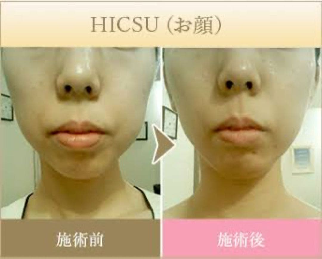 HICSU リフトアップ　業務用美容機器　たるみ　しわ　Vmax 韓国　ハイフ