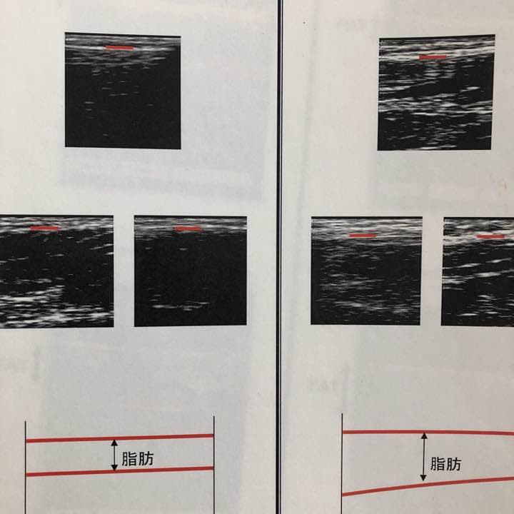 超音波画像診断器 パソコン付き　脂肪、筋肉　接骨院　エステ